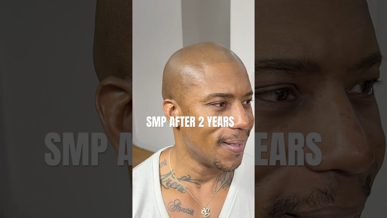 Scalp Micropigmentation After 2 years “healed results”