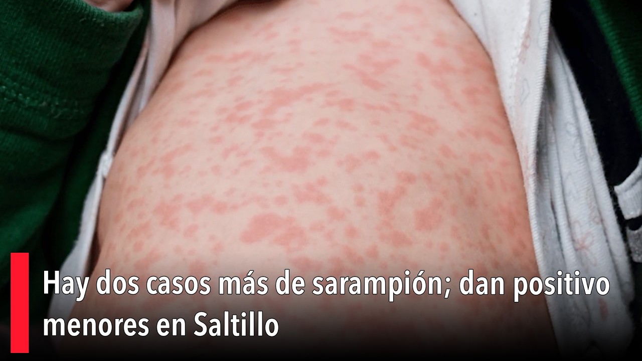 Hay dos casos más de sarampión; dan positivo menores en Saltillo