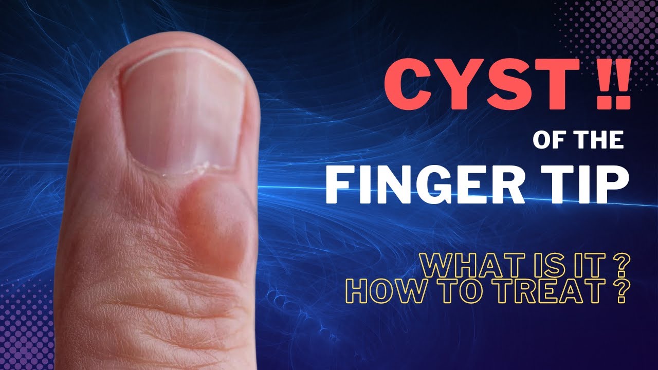 Finger Mucous Cyst : Learn to treat in 3 minutes