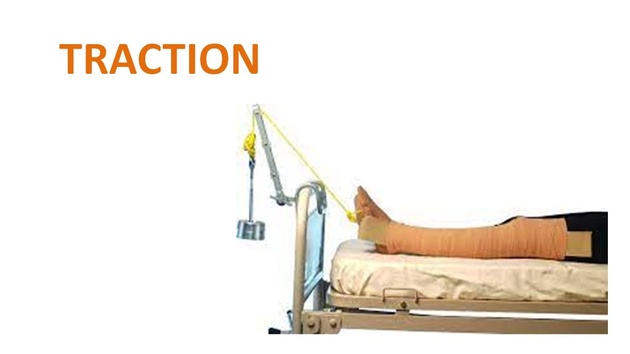 Traction: Principles, Types, Skin & Skeletal, Fixed & Sliding (Full guide)