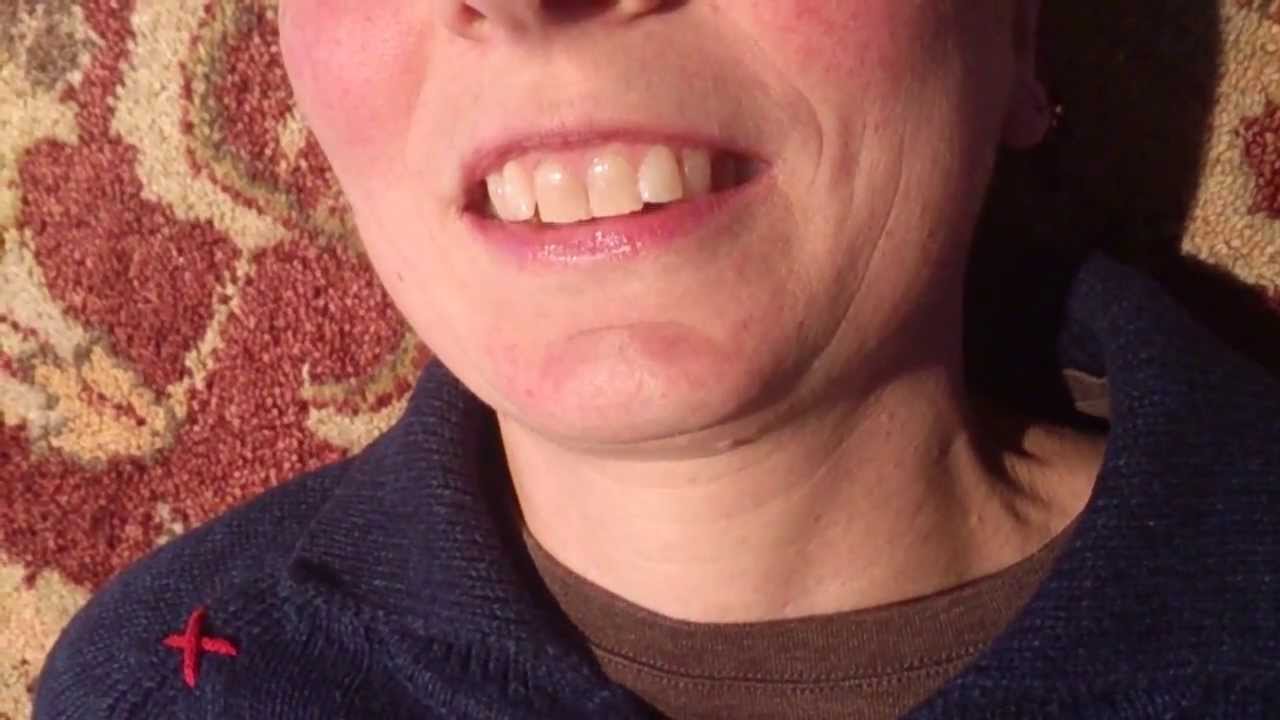 TMD: Mandible Deviation