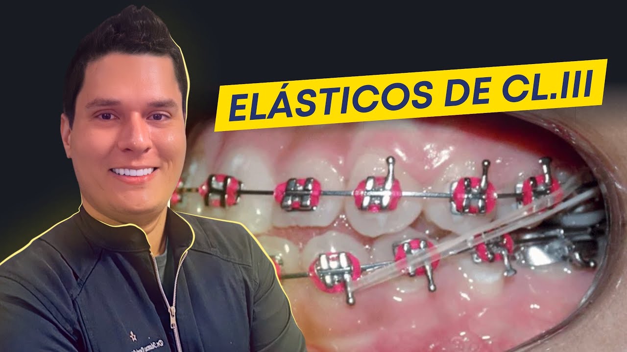 Elásticos de Classe III : 3 Formas de Usar e seus Efeitos Colaterais.
