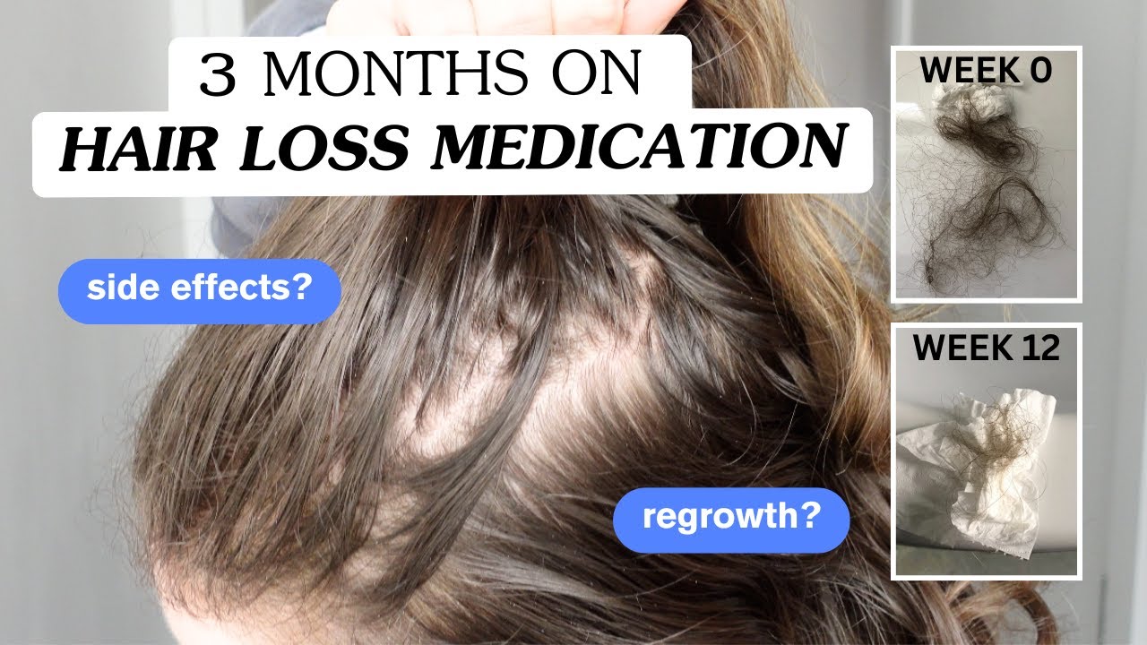 Testing the best medicine for hair loss and regrowth | minoxidil before and after results | new 2026