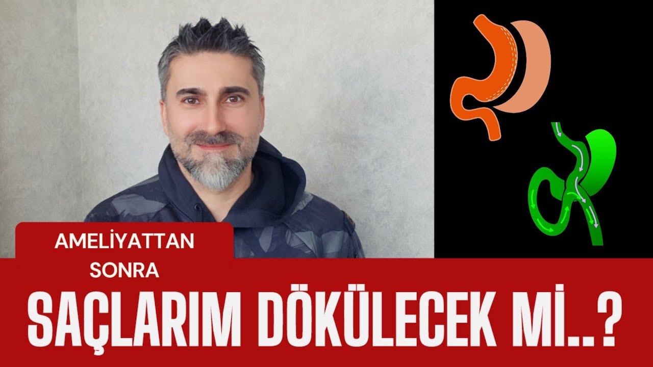 Ameliyattan sonra SAÇLARIM dökülecek Mİ? (Obezite cerrahisi, gastrik bypass, tüp mide)