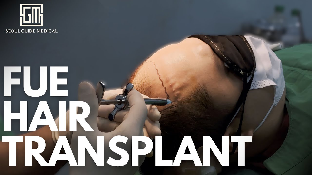 FUE Hair Transplant: Post-op Aftercare in Korea | Seoul Guide Medical
