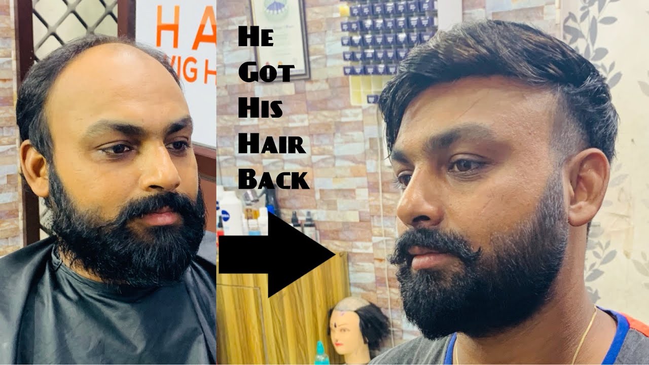 Highlighted Non Surgical Hair Replacement in Delhi & Chandigarh | 9953384242 #patch #wig