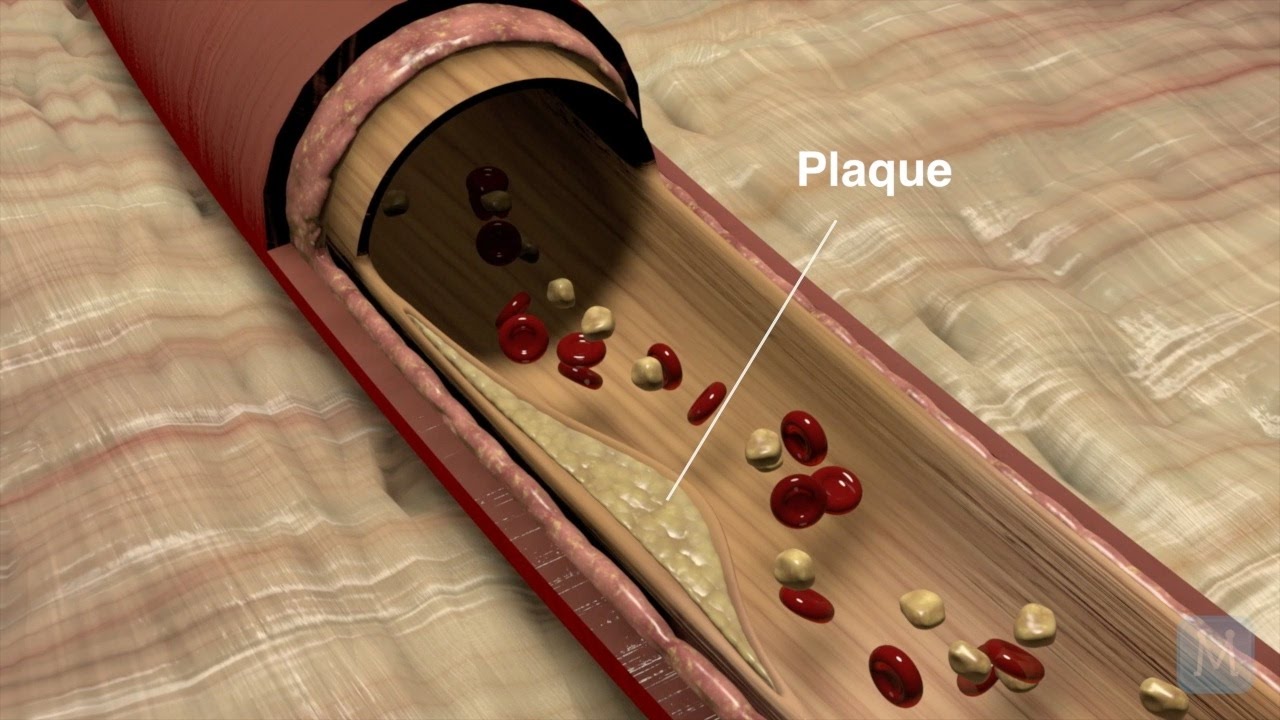 What Is Coronary Artery Disease (CAD)? | Match Health
