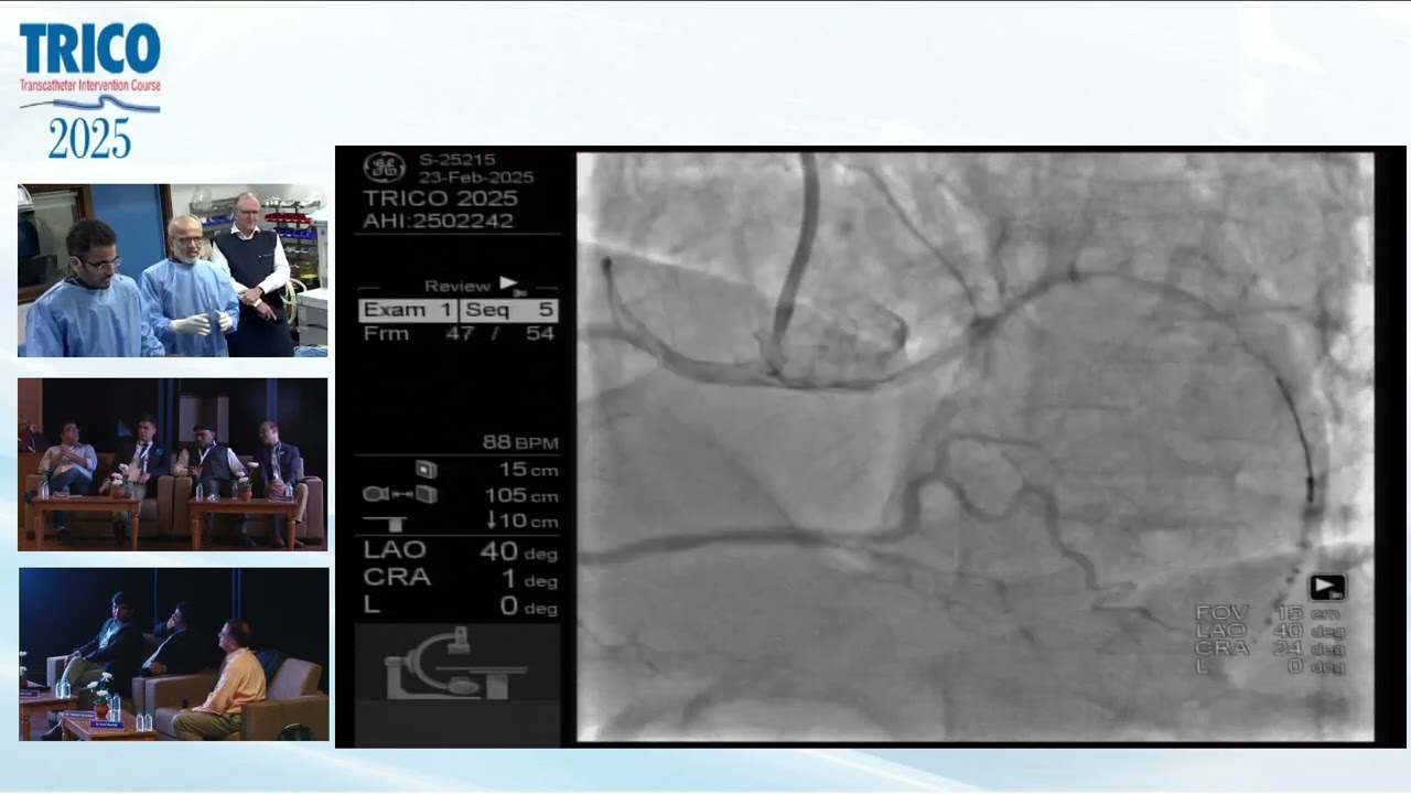 Mastering Anomalous LCX Intervention | Live Case by Dr. Tejas Patel & Dr. Aman Patel | TRICO 2025