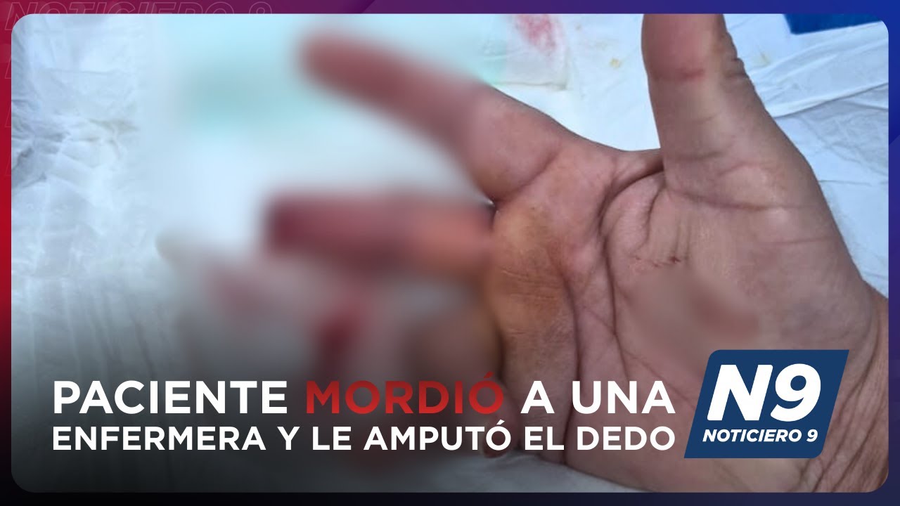 Paciente MORDIÓ A Una Enfermera Y LE AMPUTÓ EL DEDO