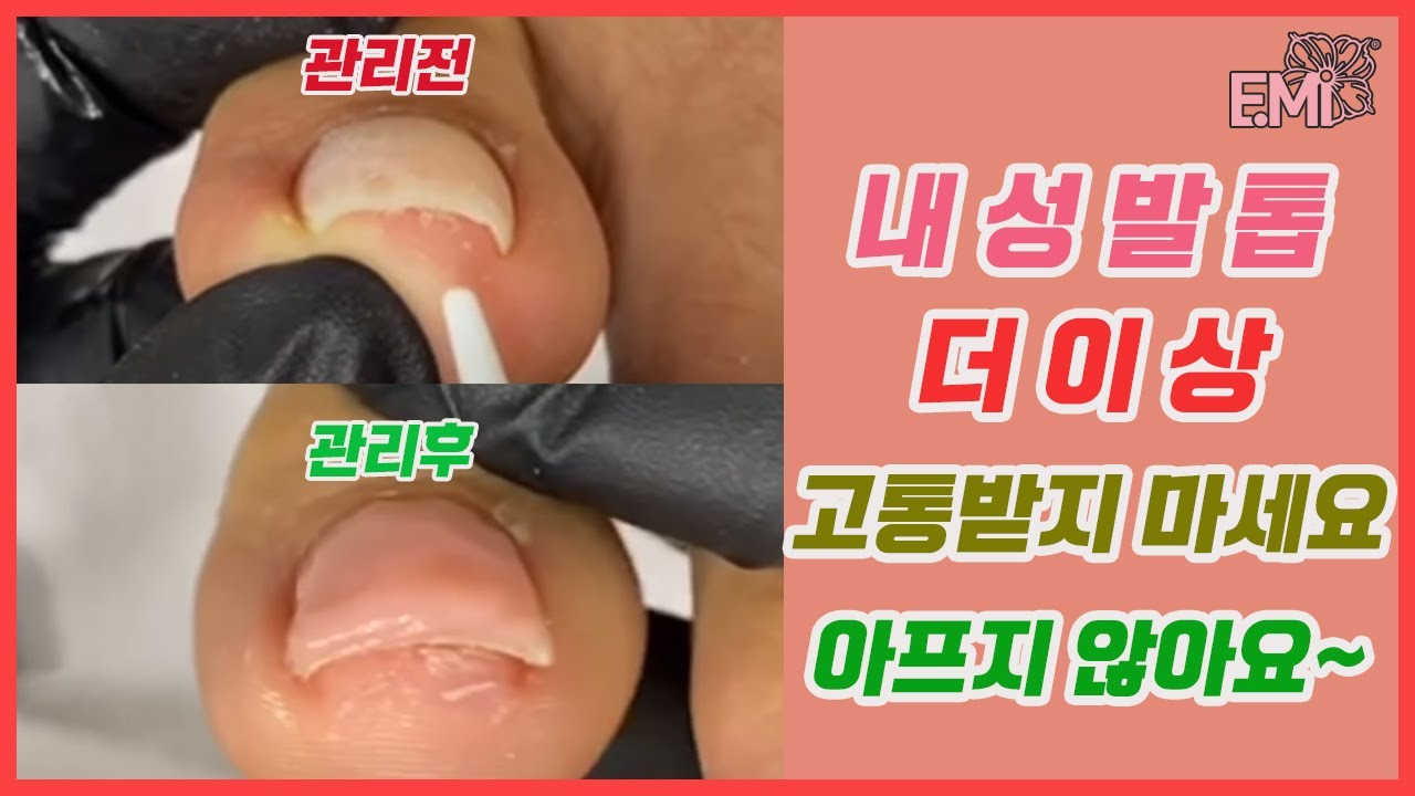 내성발톱 완전정리📍한번에 펼치면👎🏻 이영상보시면 내성발톱 역핀칭은 너무 쉬우실겁니다😅