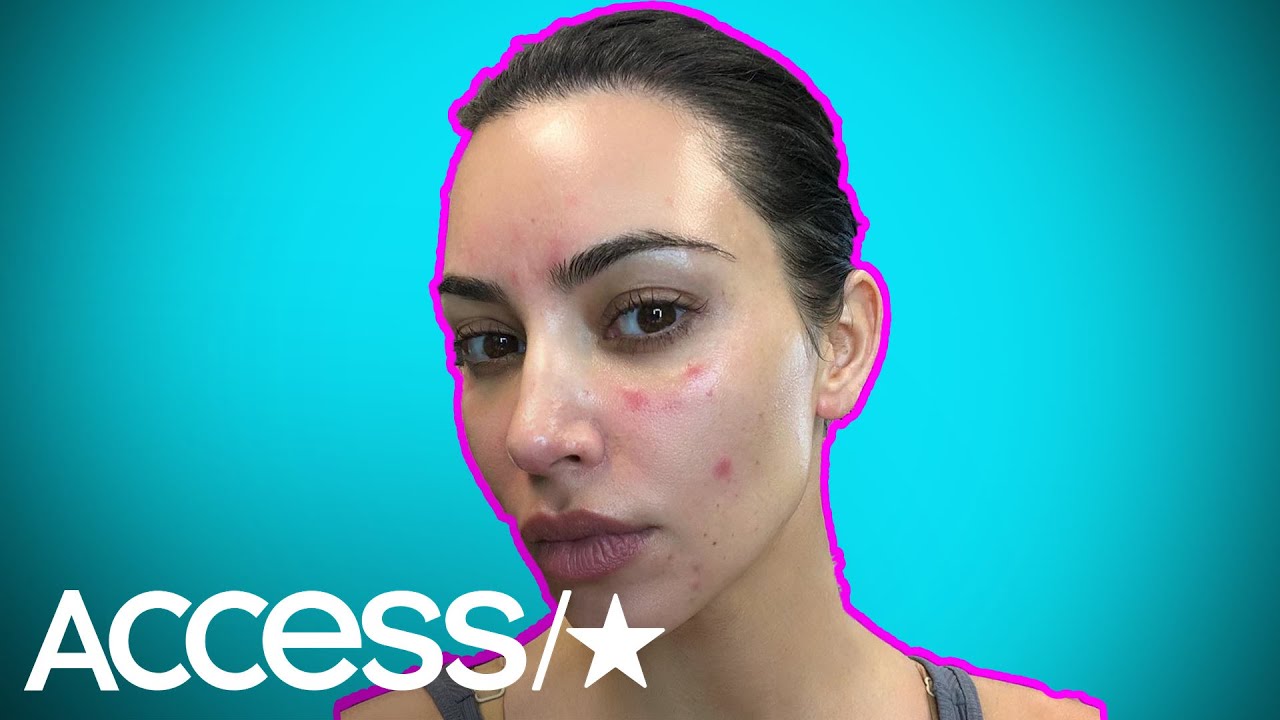 Kim Kardashian Once Tried This Strange Diet To Help Psoriasis
