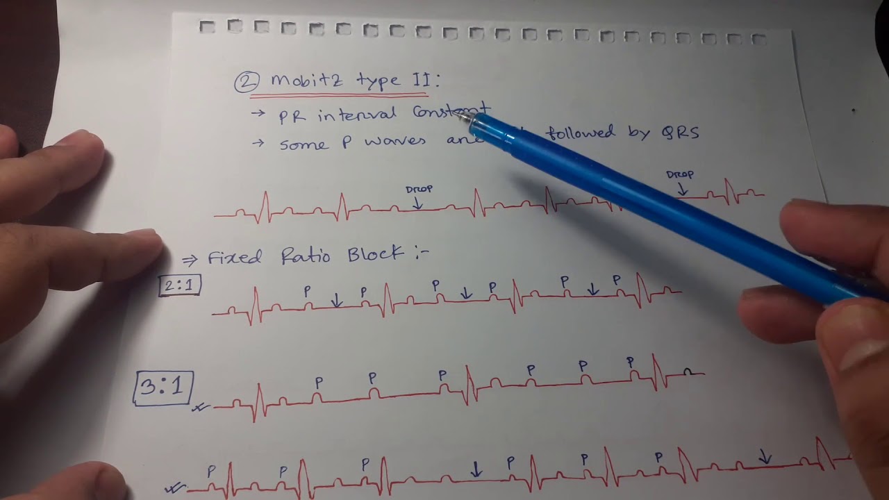 Clinical ECG Interpretation in Bangla (Part-2) : Heart blocks by 