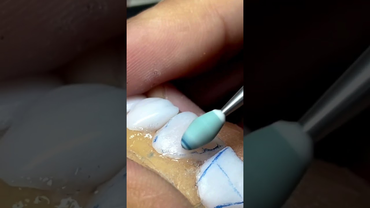 Acabamento e maquiagem em lentes de porcelana. 🚀🔥