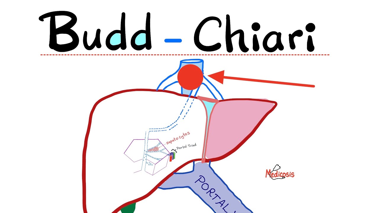 Budd-Chiari syndrome - Definition, Causes, Pathophysiology, Diagnosis & Treatment - Hepatology