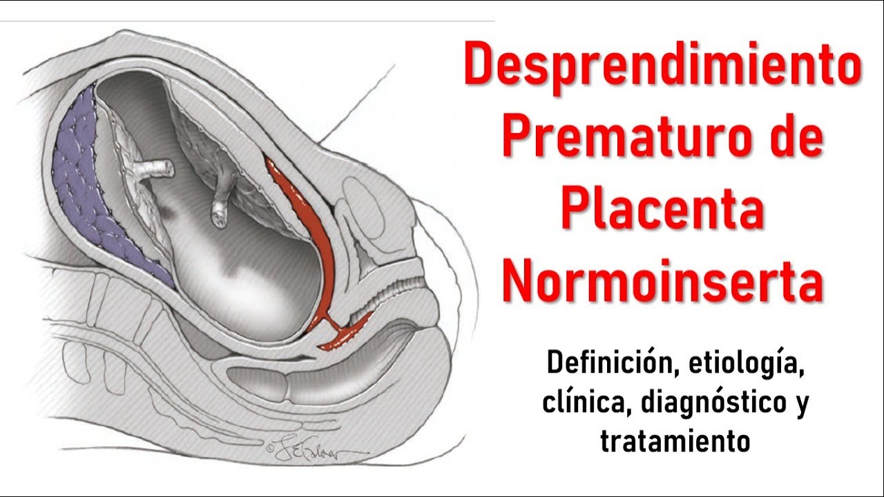 🔴 DESPRENDIMIENTO PREMATURO DE PLACENTA | HEMORRAGIA OBSTÉTRICA
