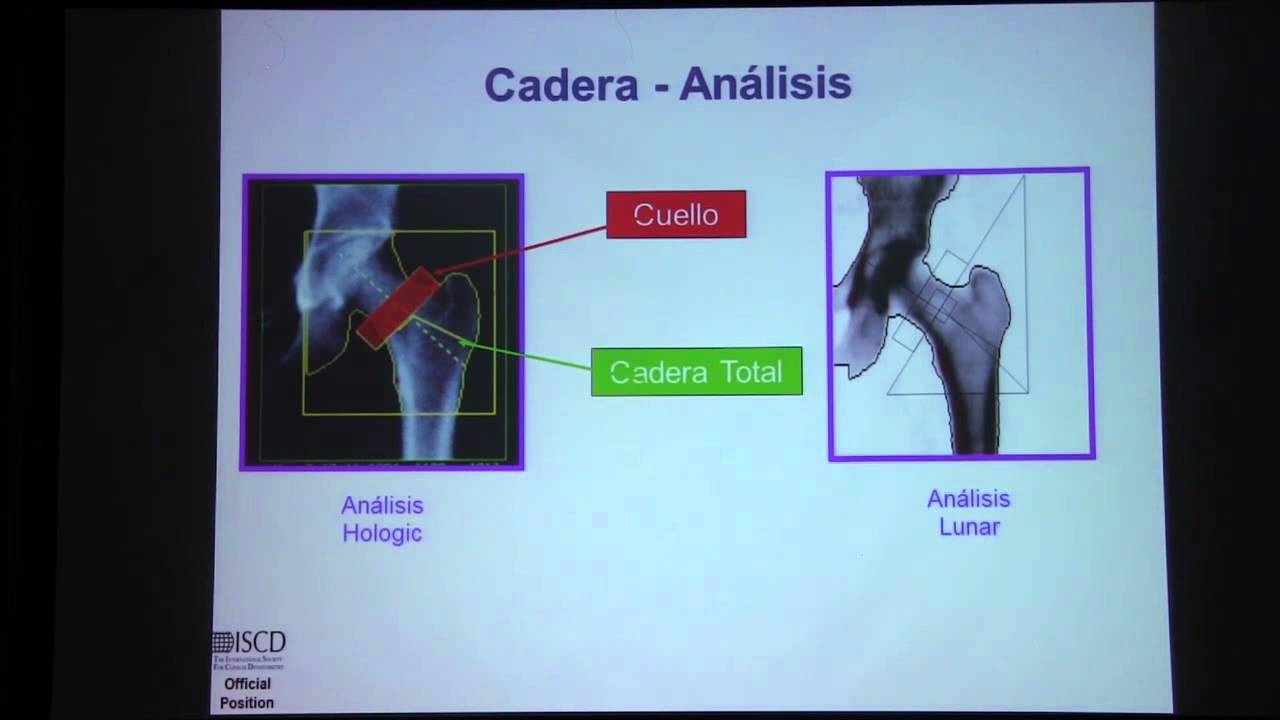 Desintometría Ósea Interpretación DEXA, posición oficial de la ISCD