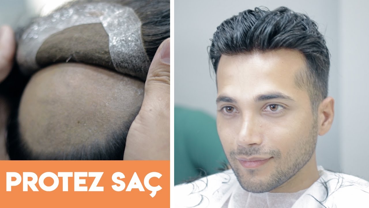 PROTEZ SAÇ UYGULAMASI - Hair Replacement