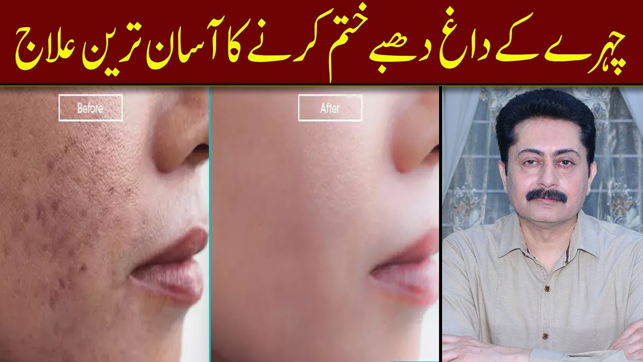 Chehre Ke Daagh Dhabon Ka Ilaj - Dark Spots Pigmentation Treatment Urdu/Hindi - Dr Faisal Syed