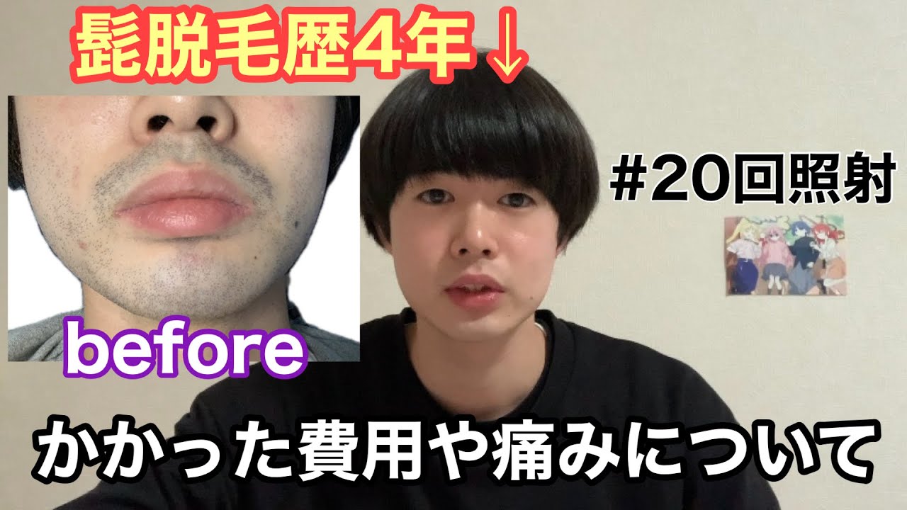 【髭脱毛】剛毛男がゴリラクリニックに4年間通った結果と感想&かかった費用を公開【20回照射/ヤグレーザー/青髭】