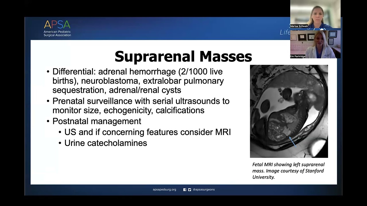 APSA Expert Talk - Abdominal Masses