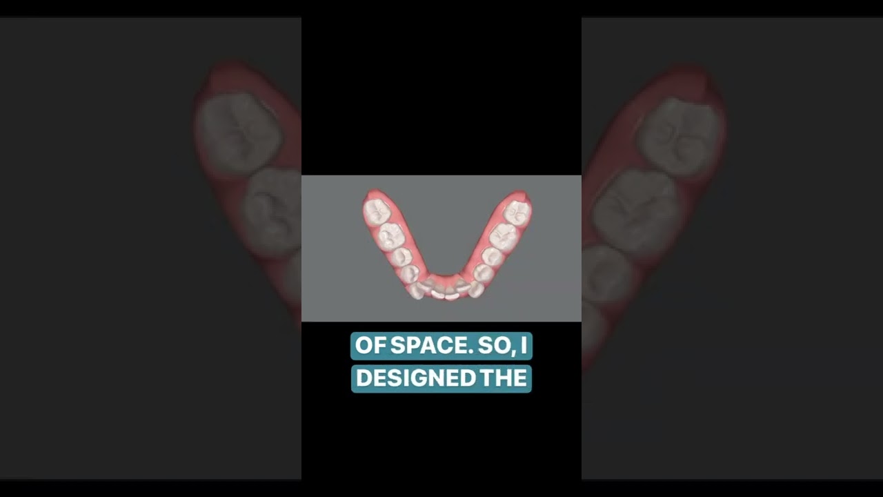 How we solve this patient&rsquo;s main concern of overcrowding with Invisalign.