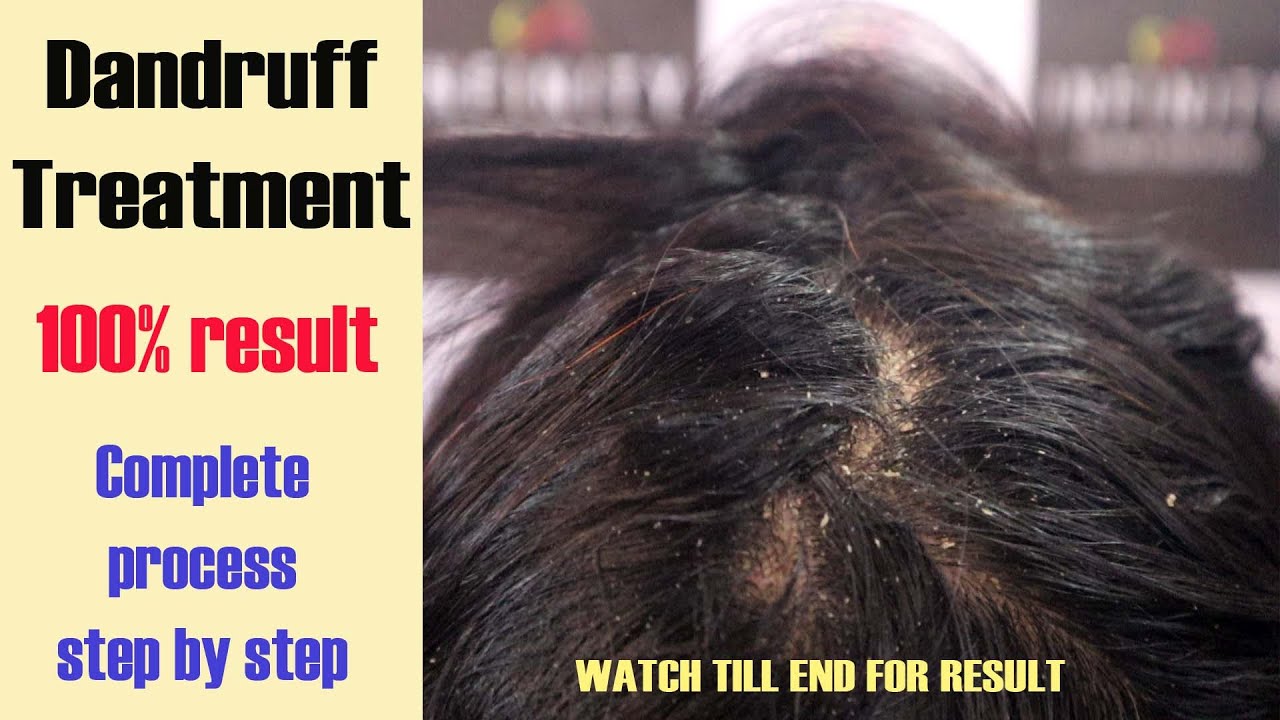 Dandruff Treatment | How to remove dandruff - complete step by step tutorial