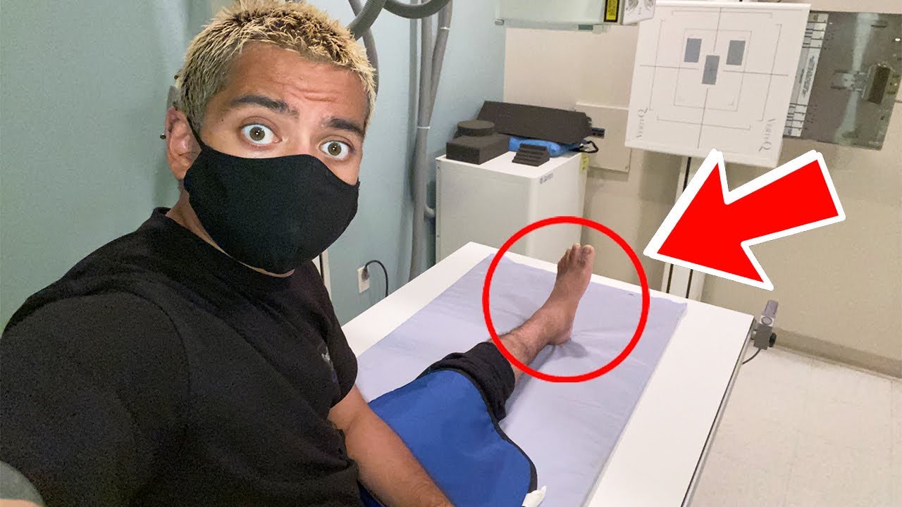 I BROKE MY ANKLE!!!