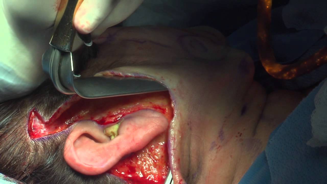 Miami Plastic Surgery - Facelift with Fat Grafting Surgery with Dr. Michael Kelly