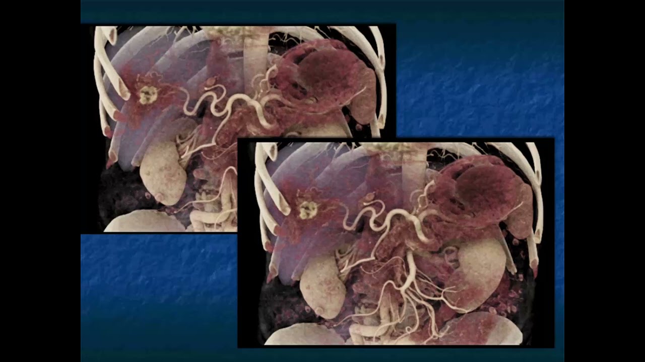 CT Evaluation of Liver Masses: Key Differential Diagnosis Pathways - Part 2