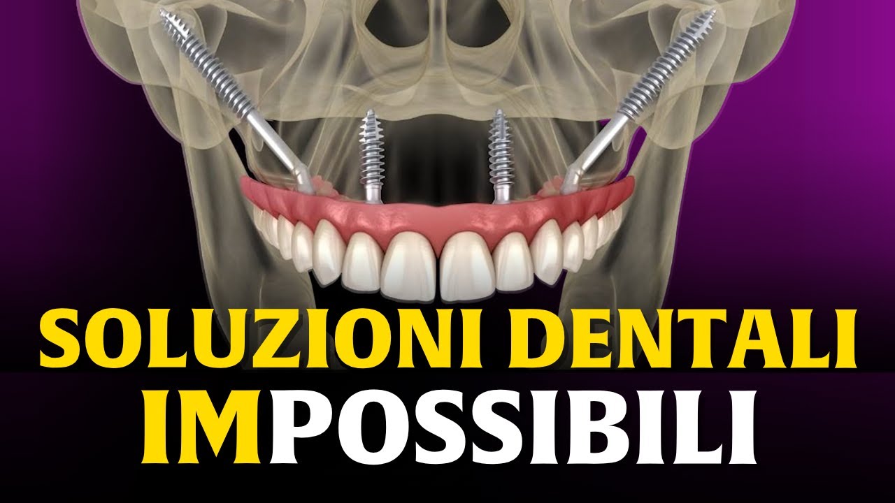 Zigomatici e pterigoidei: qualità estrema senza innesti