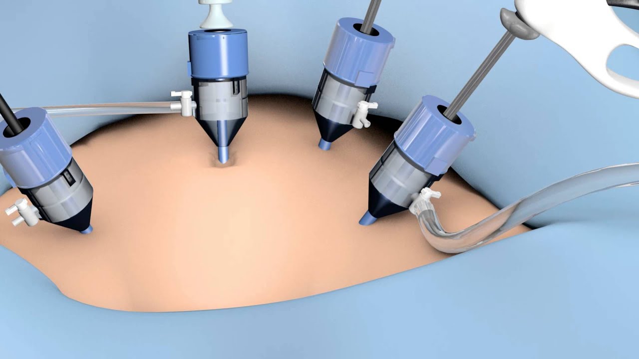 Plume-Away Laparoscopic Smoke Evacuation System Animation