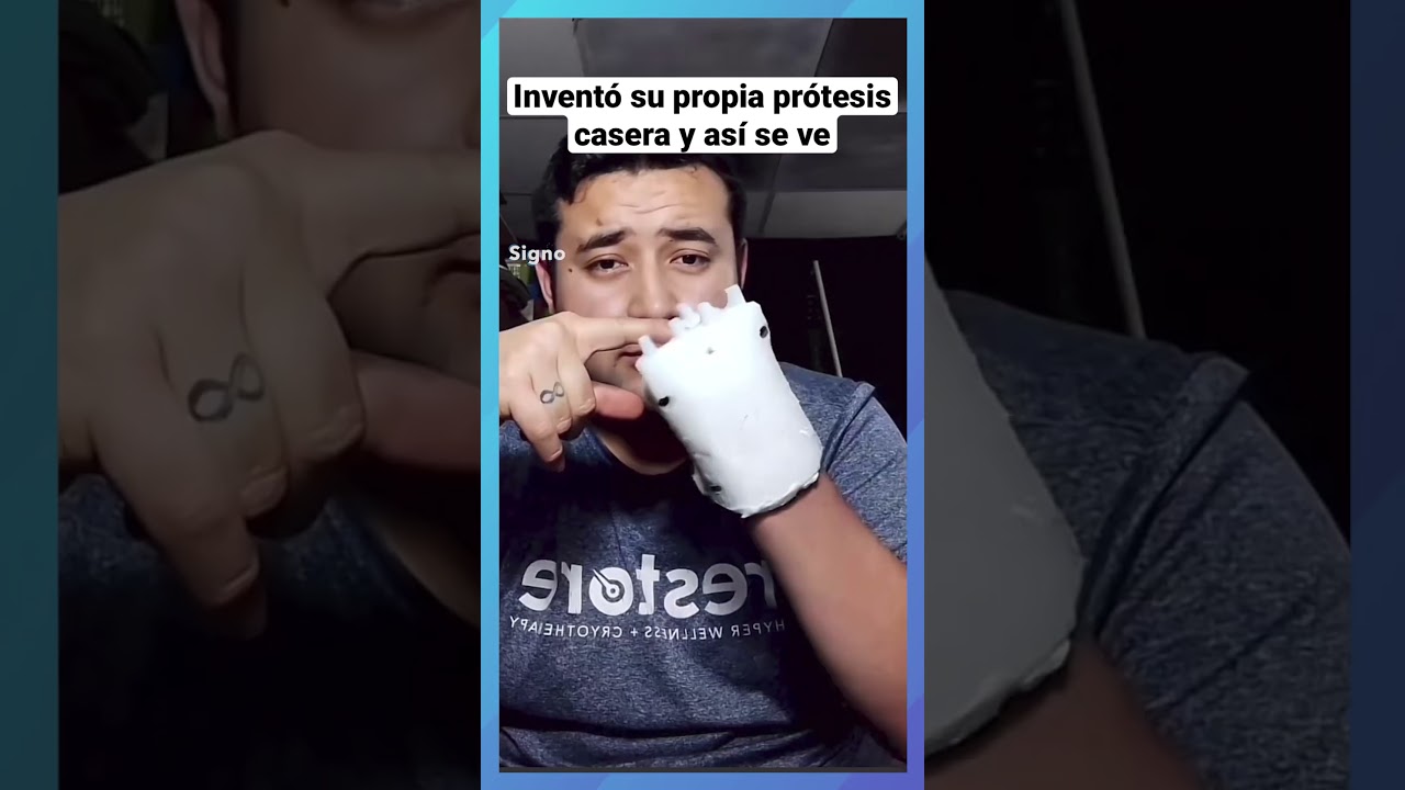 No es un profesional, pero inventó prótesis para su mano