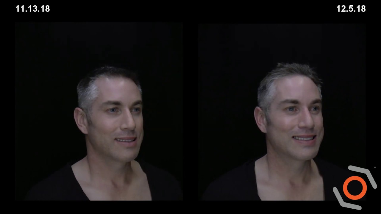 Before & After - MyEllevate™ Minimally Invasive Facial Rejuvenation Treatment
