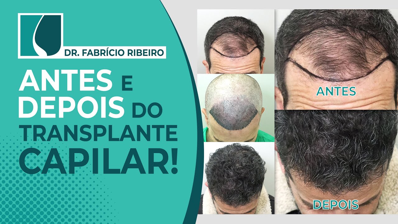Resultado de Transplante Capilar Antes e depois .