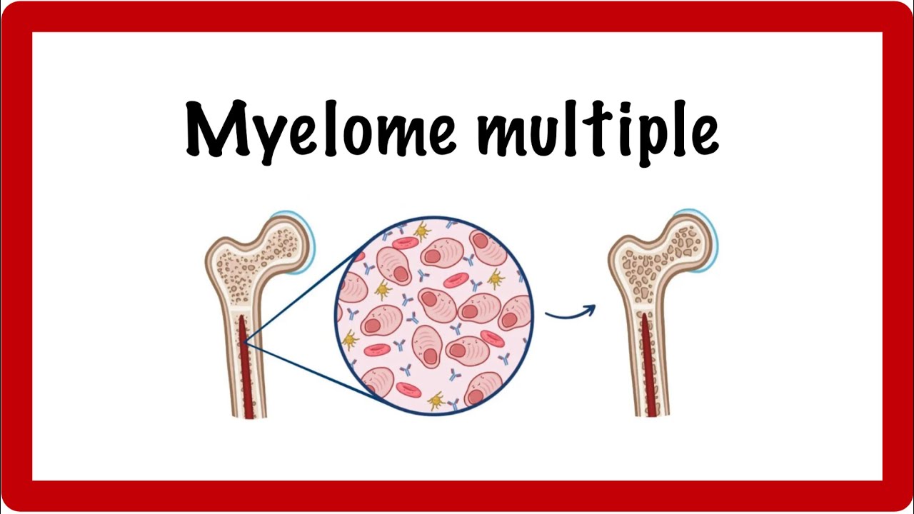 Myelome multiple