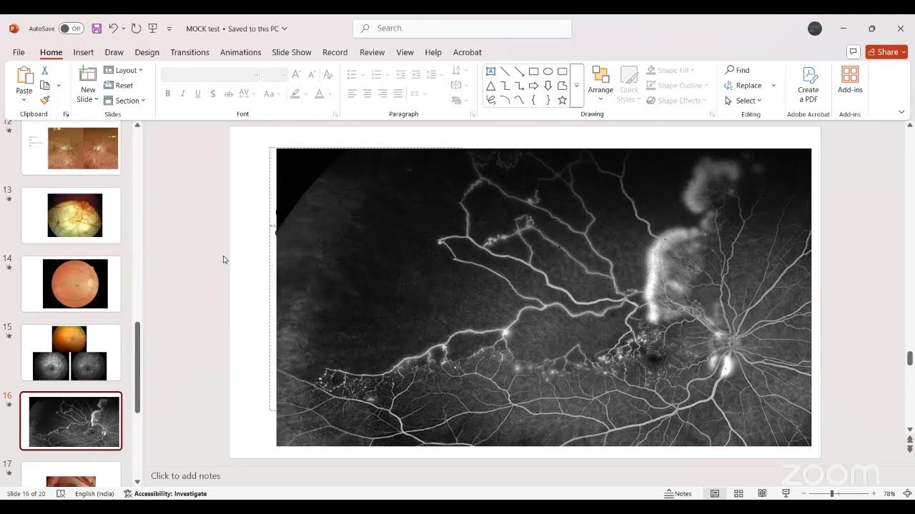 [MVUPGO] Retina mock exam with Dr Abhishek Desai [India] 17 June 2025