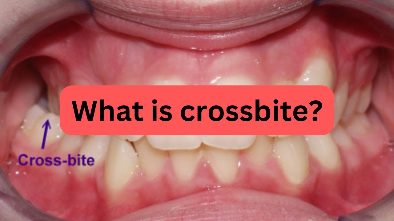 Crossbite Vs Deepbite: The DIFFERENCE You Need To Know!