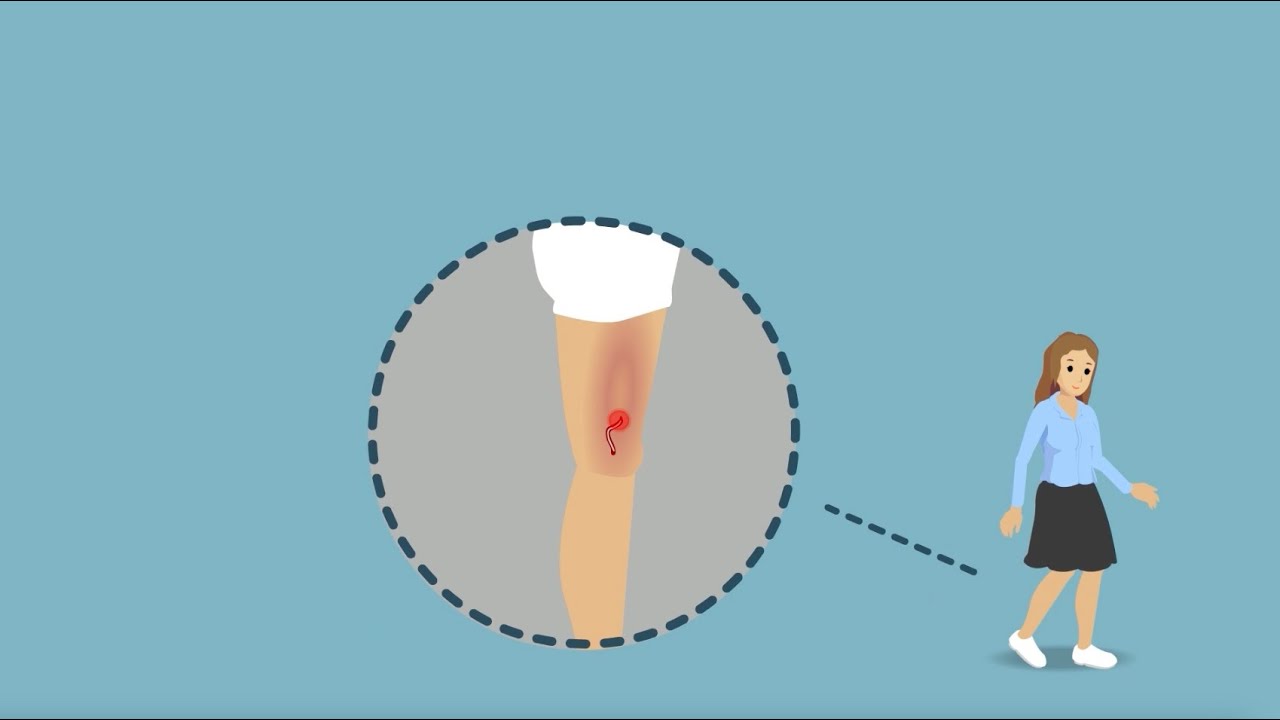 Laserbehandeling spatader (endovasculaire laser therapie)