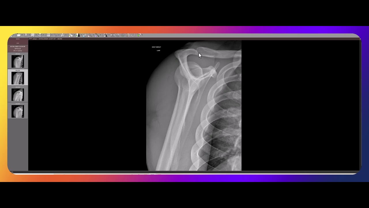 Comment interpr&eacute;ter une radiographie de l'&eacute;paule ?