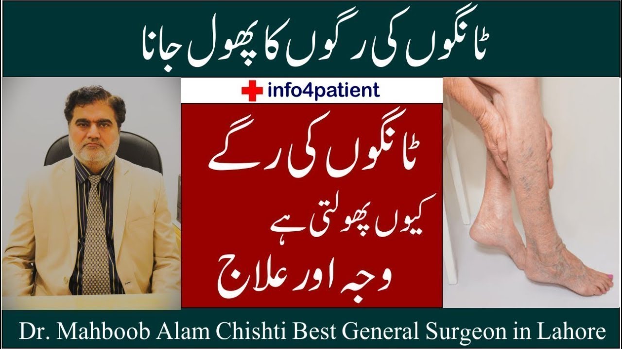 Treatment for Varicose Veins ٹانگوں کی رگوں کا پھول جانا | in Urdu / Hindi  Dr. Mahboob Alam