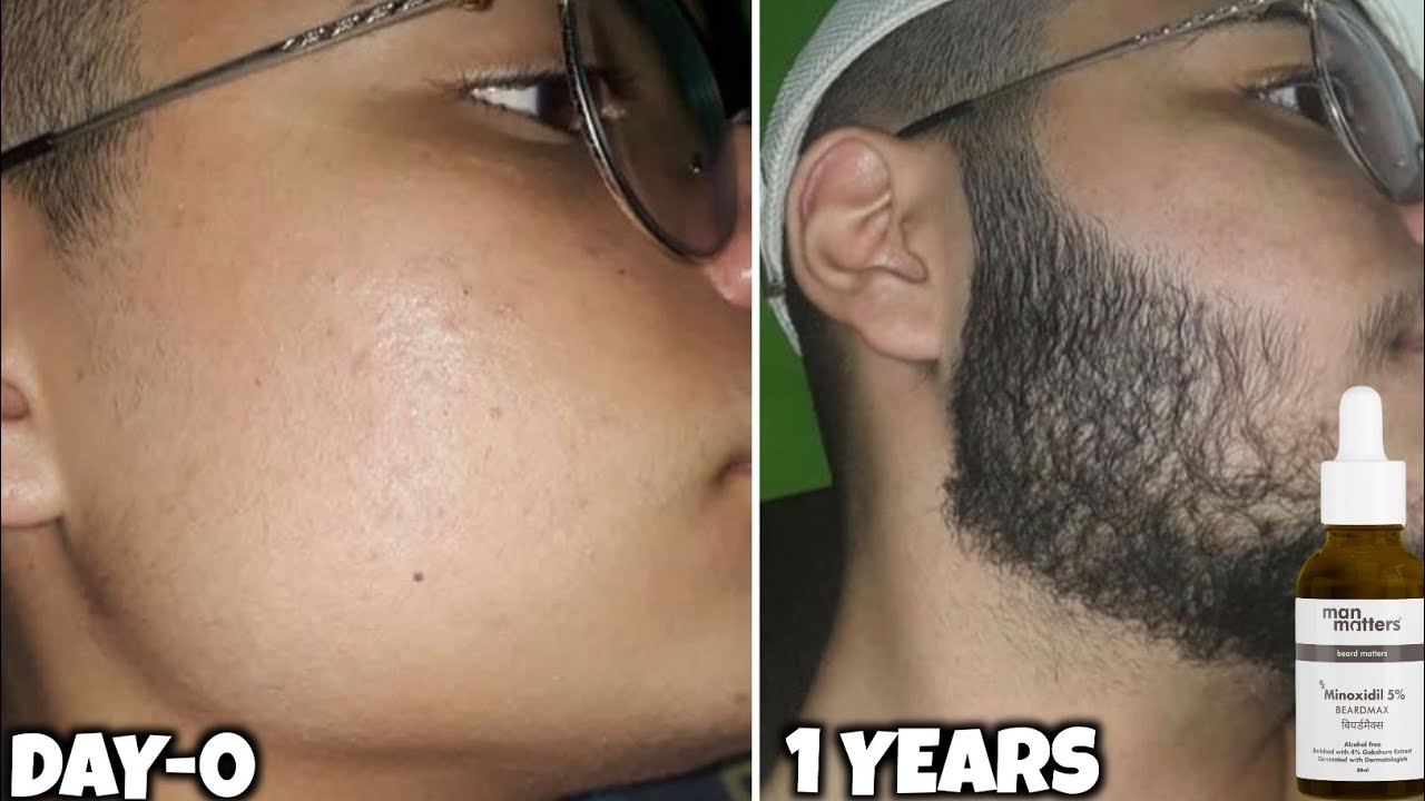 365 Days of Minoxidil for Beard Growth  | Before & After Results | minoxidil beard growth results |