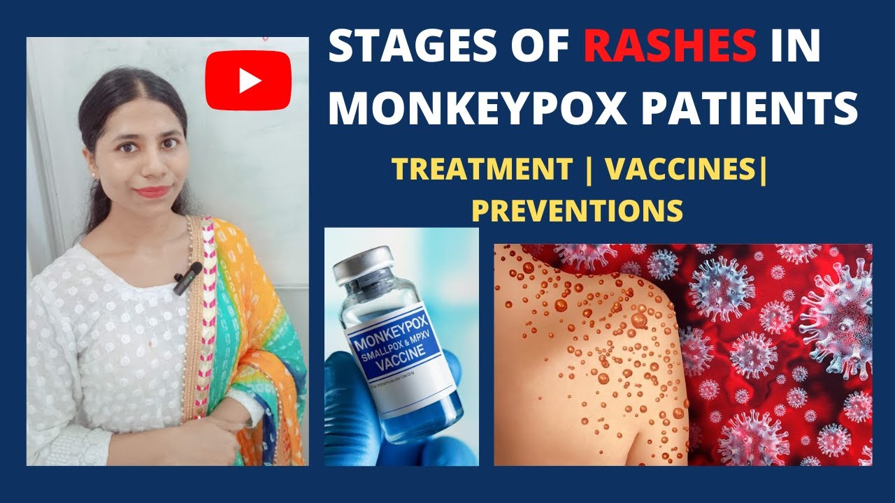 How long does monkeypox rash last?  || Rashes Stages || Treatment || Vaccines || Preventions