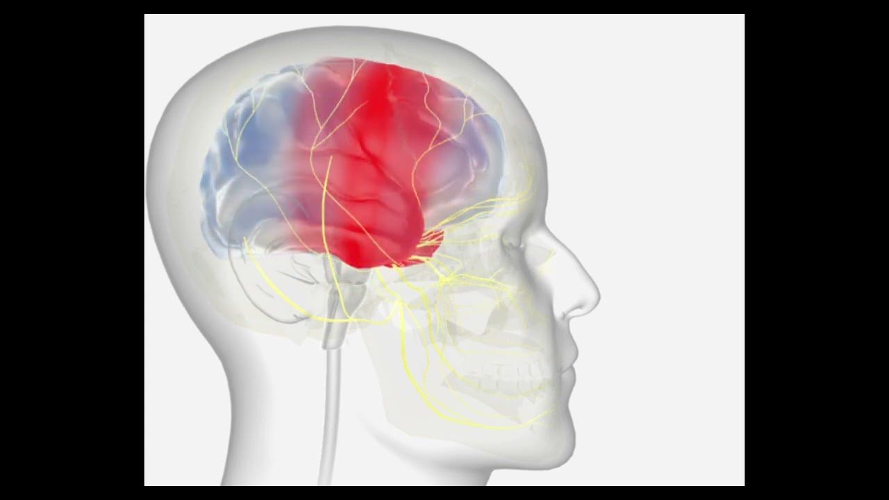 Pathophysiology of migraine - Samira Berdié Alfàs