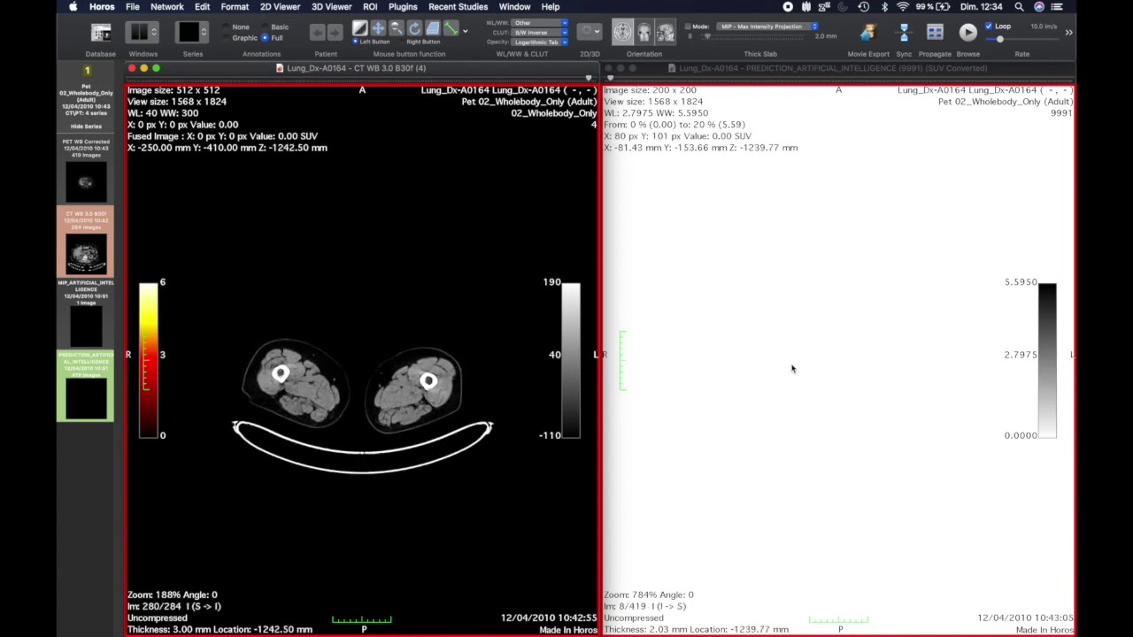 Inference of a PET detection model using the Jetson Nano (NVIDIA) and Horos
