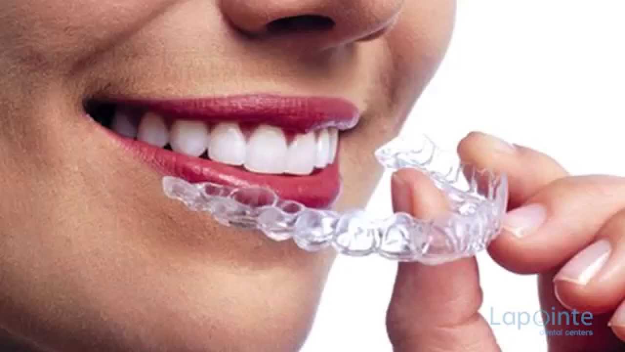 Teeth whithening at home - Lapointe dental centres