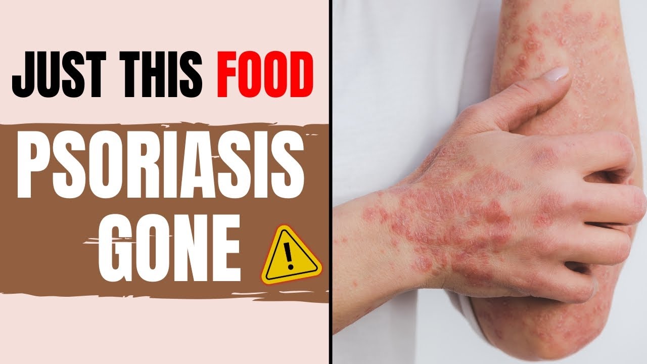 Scalp Psoriasis Gone With This Anti-inflammatory Breakfast Diet