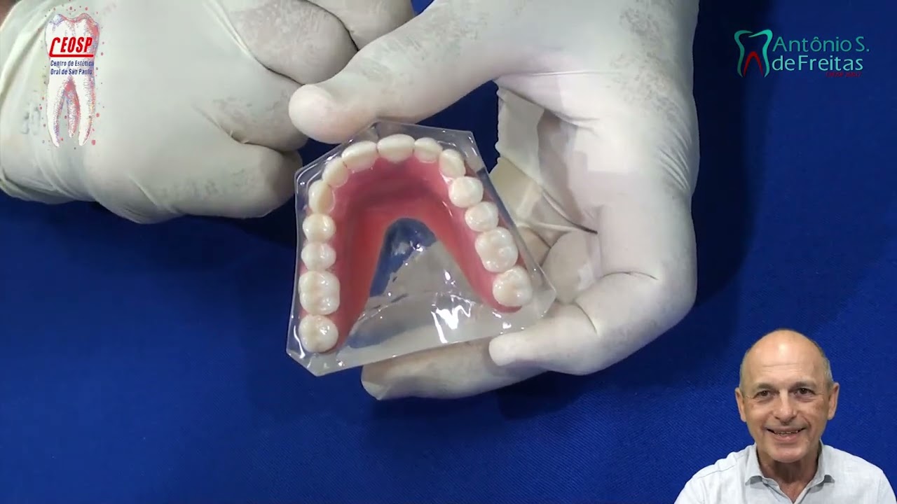 Como é a Overdênture sobre 4 implantes (barra/bola). Dr. Antônio Sergio F Freitas