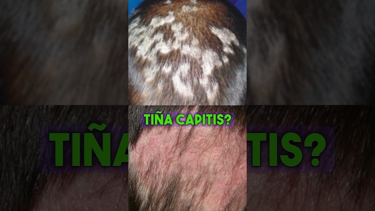 Tratamiento para Ti&ntilde;a Capitis #ti&ntilde;acapitis  #tratamiento  #salud  #griseofulvina #viralvideo