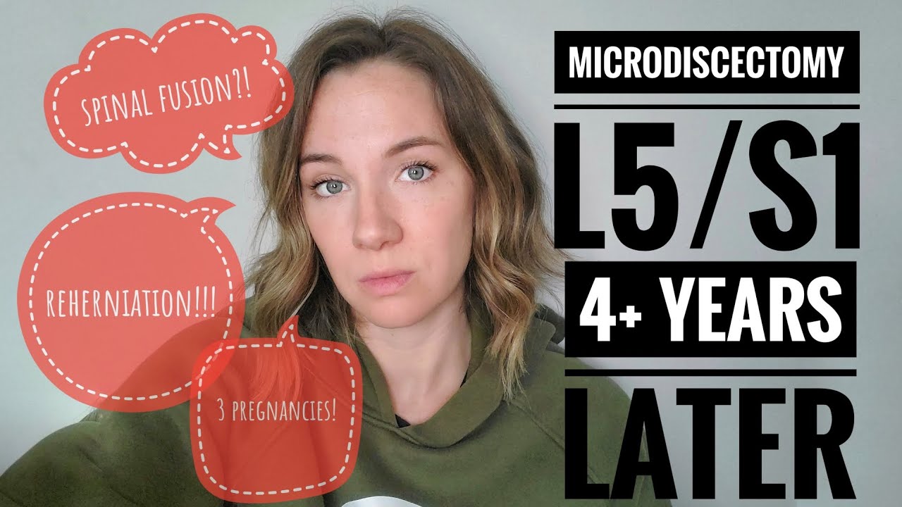 Update 4+ years after microdiscectomy at L5/S1 (Reherniation!)