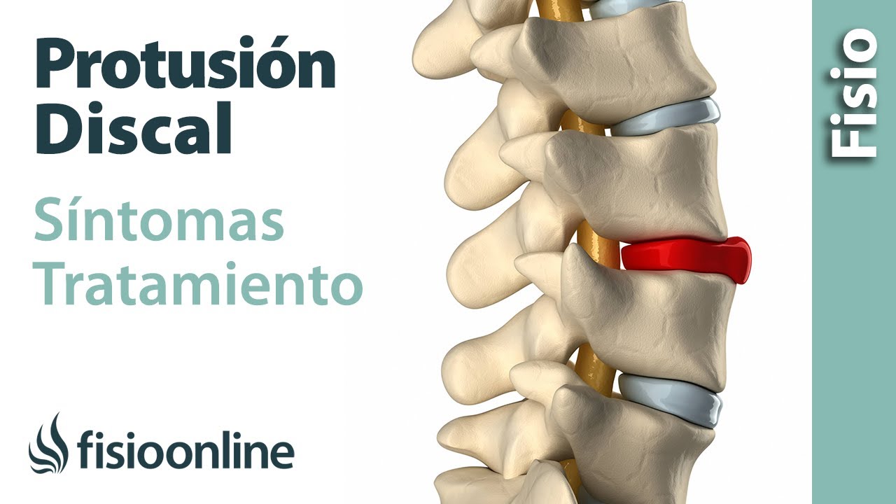 Protrusión de disco o discal - Qué es, causas, síntomas y tratamiento